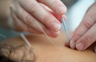 Acupuncture for migraines (Image via Unsplash/Katherine Hanlon)